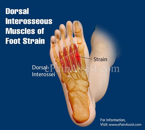 Dorsal Interosseous Muscles of Foot Strain | Treatment recovery, Muscle ...