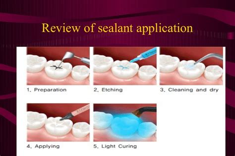 Pit and fissure sealants