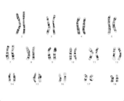 Human karyotype :: G-banding