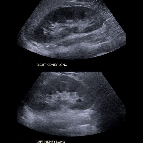 Normal Kidney Ultrasound