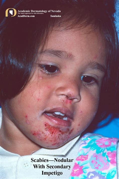 Parasitic Diseases: Scabies - Academic Dermatology of Nevada