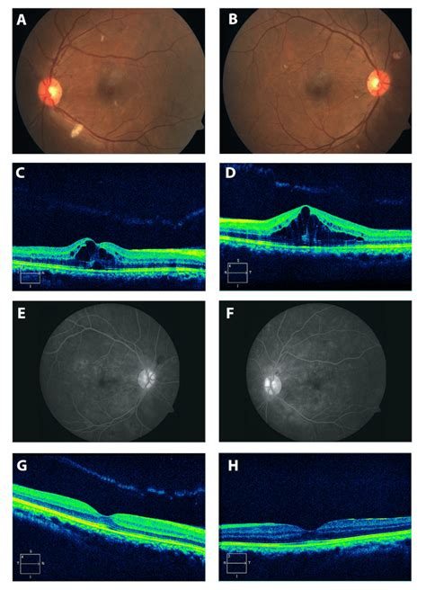 A,B: Fundus photograph (at initial presentation) of the right and left... | Download Scientific ...