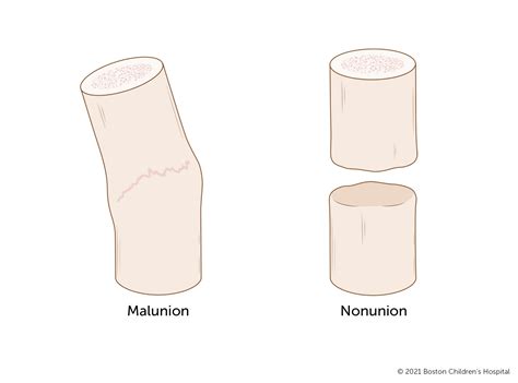 Malunion Fracture | Boston Children's Hospital