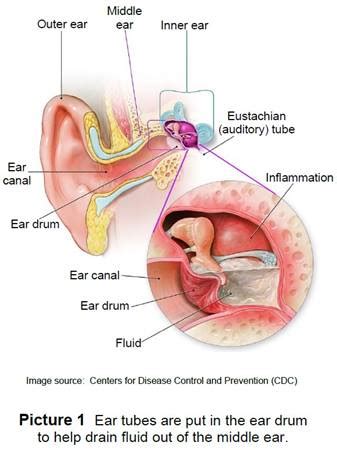 Tinnitus and Fluid Behind the Eardrum - Pulsatile Tinnitus