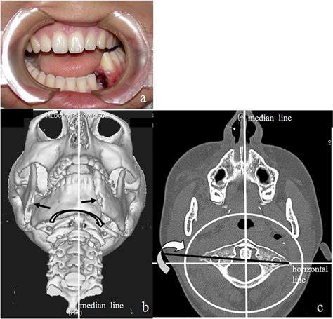 Mandibular Jaw Fracture