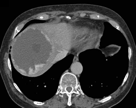 13 cm Giant Cavernous Hemangioma of the Liver - Liver Case Studies - CTisus CT Scanning