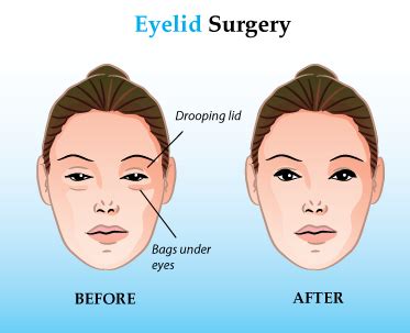 Eyelid Surgery (Upper & Lower) Cost, Recovery Time, etc.