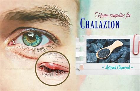 45 Natural Home Remedies For Chalazion Cysts On The Eyelid