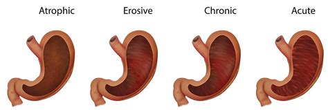 Atrophic gastritis: causes, symptoms forecast and treatment