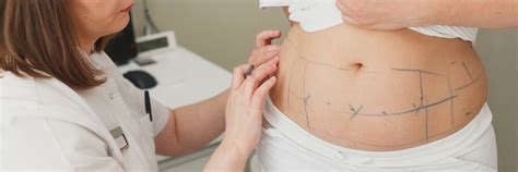 Things to look for Within The Ideal Liposuction Clinic - V6 Online Pharmacy - Your Diet and ...