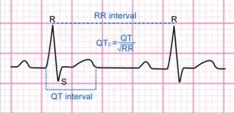 The Normal ECG