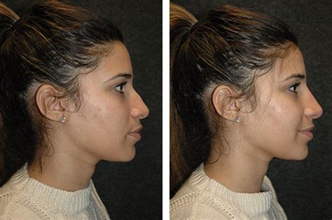 Non-Surgical Nose Job | New York, NY