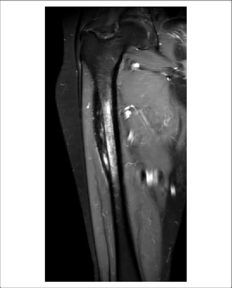 Right femur MRI shows lateral cortical thickening of the proximal femur ...