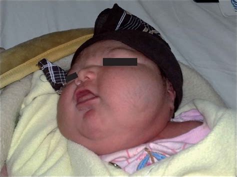 Cystic hygroma in fetus & in adults, causes, prognosis and treatment