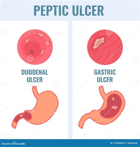 Types Of Peptic Ulcer Disease