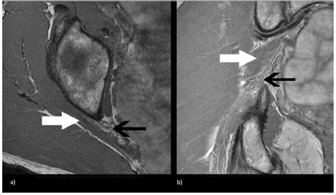 Sciatic Foramen Mri