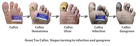 Diabetic Gangrene stages-Great Toe Base - Podiatry Doctor