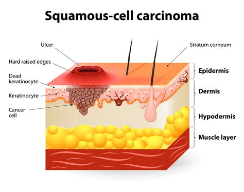 Squamous Cell Carcinoma (SCC) - CBD Skin Cancer Clinic