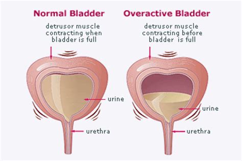 Overactive Bladder Syndrome Vs Urge Incontinence