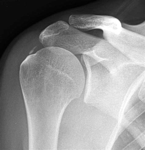 SplintER Series: A Case of Severe Shoulder Pain