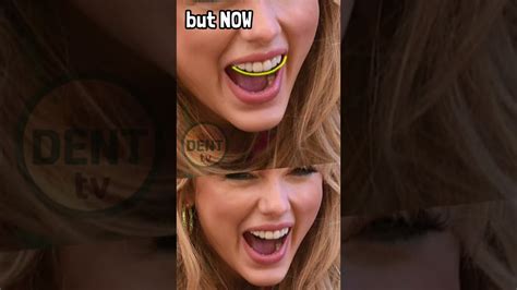 Taylor Swift Before And After Veneers