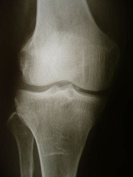 What Is A Bone Spur And Treatment