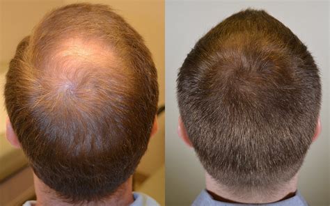 Propecia Hair Loss Case Study - Hair Restoration of the South