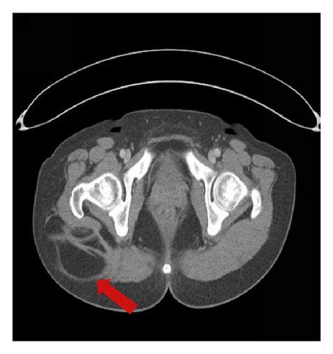 Case 12. (a) Intraoperative clinical photography. ( : intramuscular... | Download Scientific Diagram