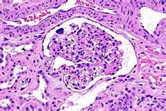 Cystinosis - Libre Pathology