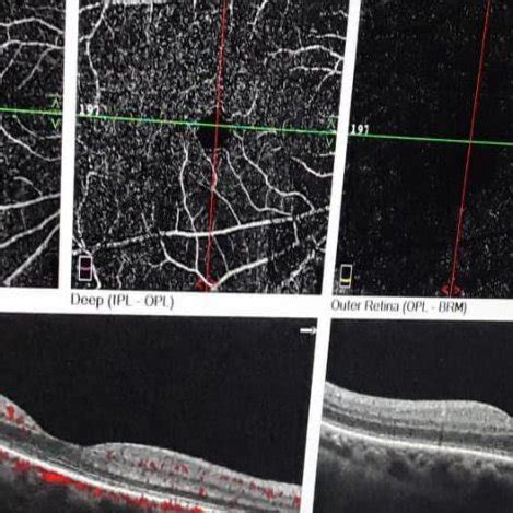 Normal OCT angiography | Download Scientific Diagram