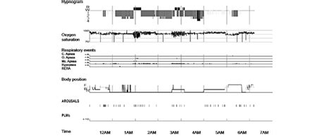 Polysomnography recording in Case 1. First night diagnostic nocturnal... | Download Scientific ...