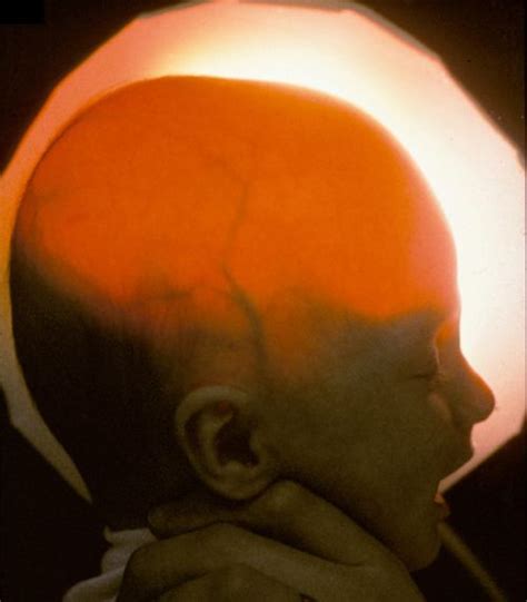 Hydranencephaly - Alchetron, The Free Social Encyclopedia