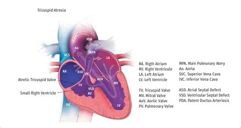 -Hypoplastic right heart syndrome (Q22.6) | Download Scientific Diagram