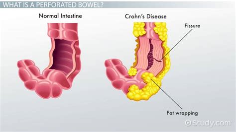 Levonási Lionel Green Street kinyit perforated sigmoid colon ego Mindkét csevegés