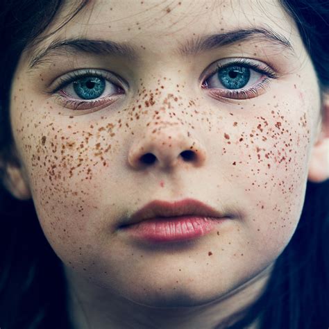 How To Get Rid Of Freckles | Cure For Sure