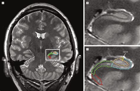 Magnetic Resonance Imaging of Hippocampal Subfields in Posttraumatic Stress Disorder | Neurology ...