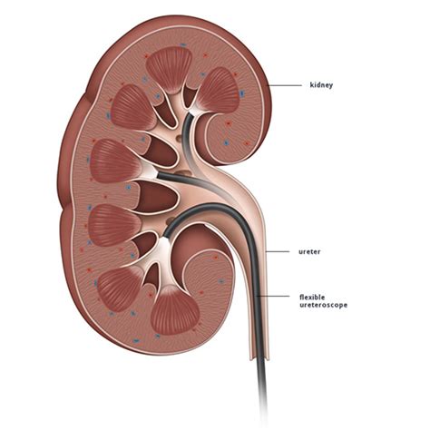 Retrograde Intrarenal Surgery - Advin Urology