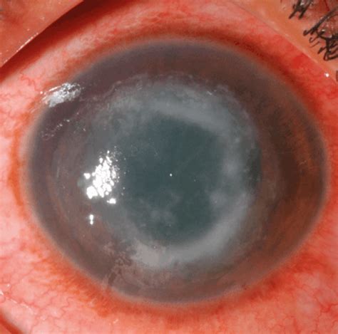 How to diagnose and treat Acanthamoeba keratitis | Eye News