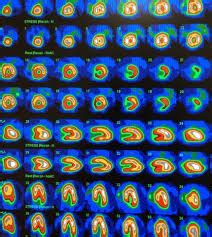 Radionuclide cardiac imaging (MUGA scan)