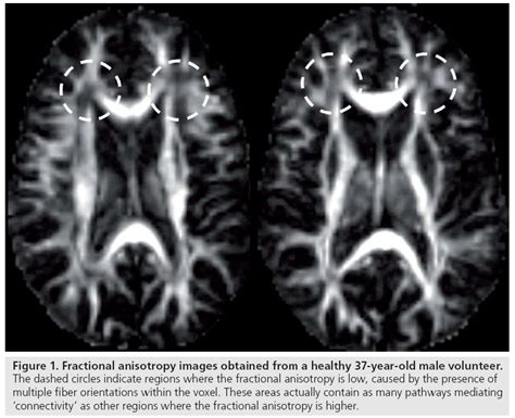 Challenges and limitations of quantifying brain connectivity in vivo with diffusion MRI