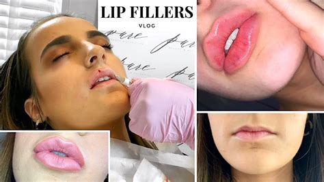 1 5ml Lip Filler Before And After Thin Lips | Sitelip.org