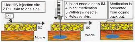 z track method for IM injections with rationale | Im injection, Nursing school, Mentorship