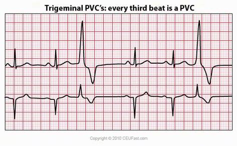 CEUfast.com - trigeminal pvc | Ecg interpretation, Ekg, Cardiac nursing