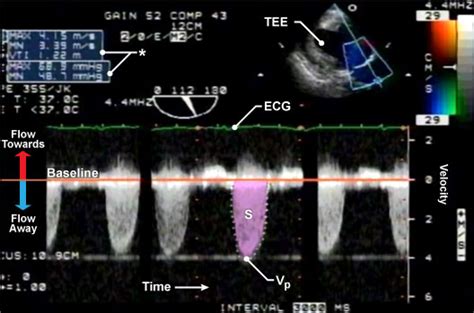 Virtual Transesophageal Echocardiography