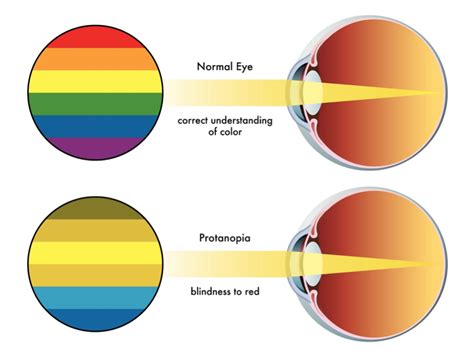 Color Blindness Treatment | IrisTech