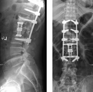 Case Study: Burst Fracture 1 - New York City Spine