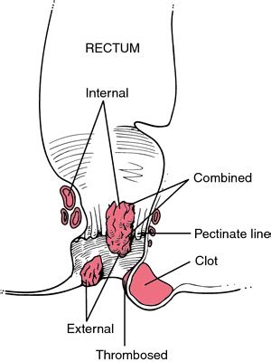 Home Remedies for Hemorrhoids – Information and Natural Treatments | Home Remedies Log