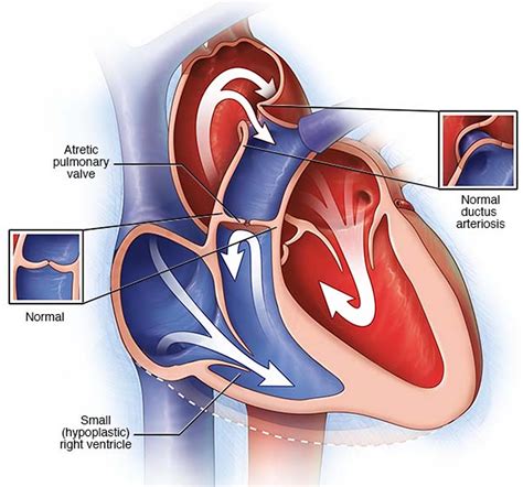 Pulmonary Atresia - Causes, Types, Symptoms, Diagnosis & Treatment