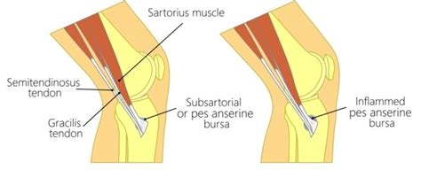 Bursitis Pes Anserinus, Dalang Sakit Lutut Bagian Dalam