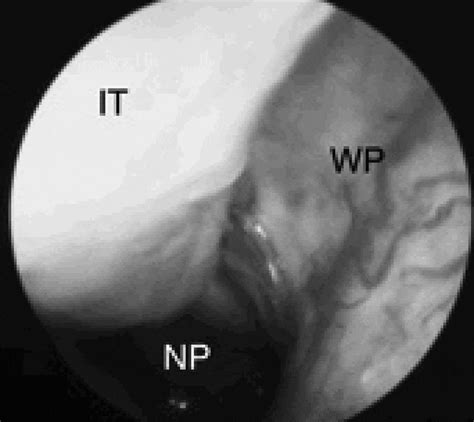 Woodruff's plexus | The Journal of Laryngology & Otology | Cambridge Core